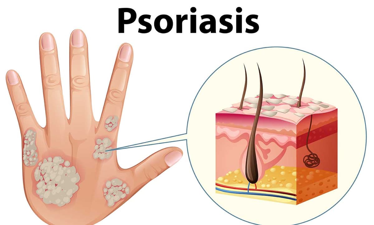 Es posible prevenir la psoriasis