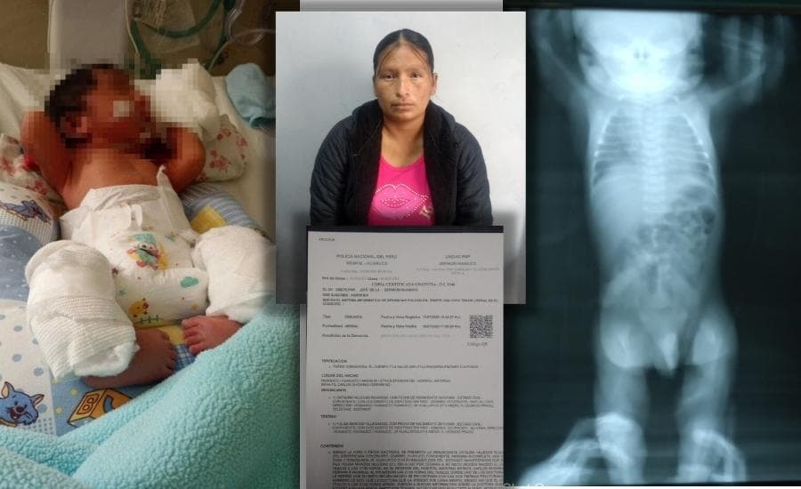 Denuncian que doctora del Hospital Carlos Showing fracturó piernas de bebé