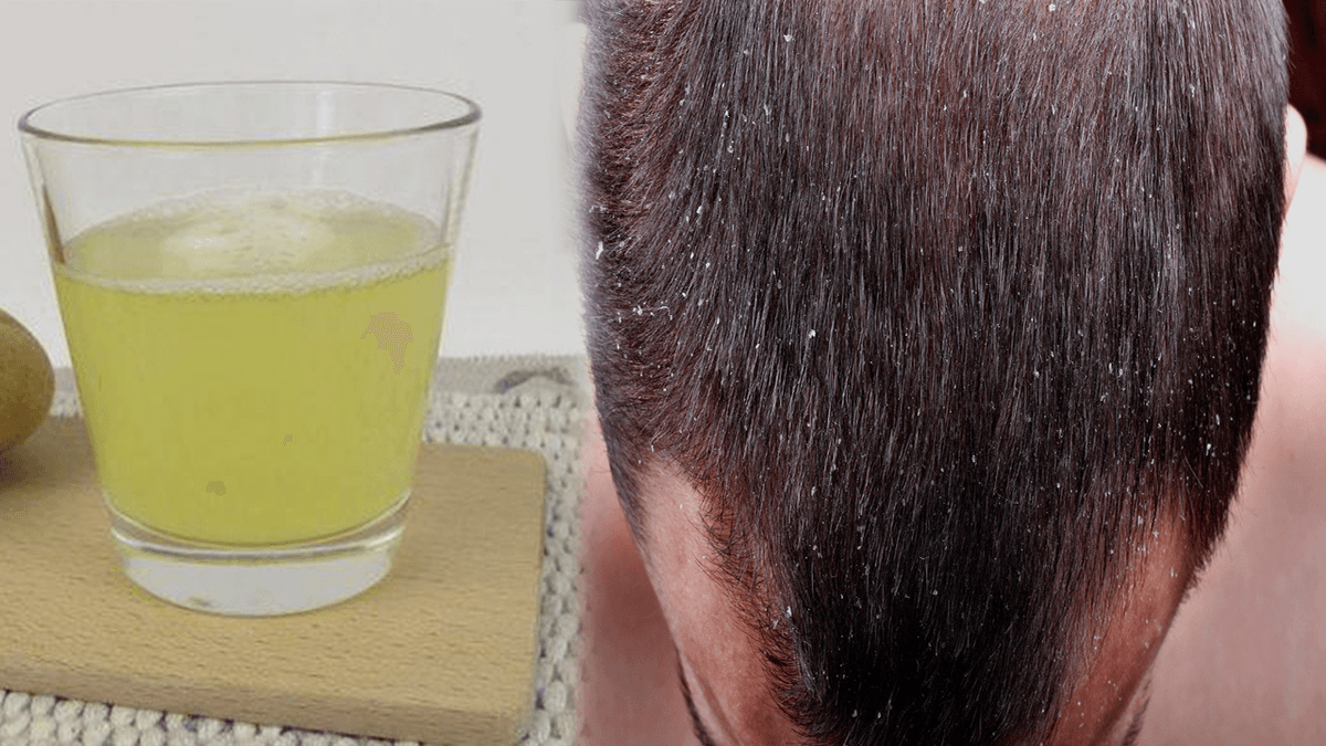 La Caspa del cabello se puede controlar con remedios naturales