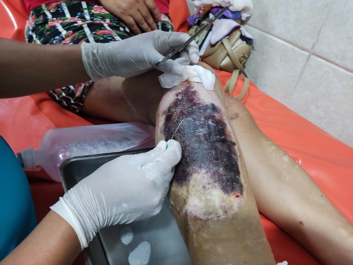 Personal de salud en Castillo Grande evita amputación con atención oportuna