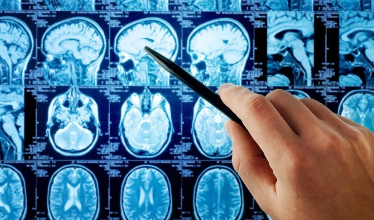 "Niebla cerebral" en pacientes COVID-19 se asociaría a tormenta de citosinas