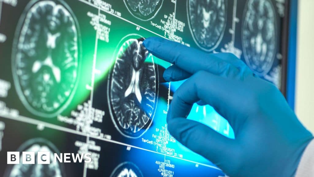 Informe: Fármacos Alzheimer no tendrían beneficios en pacientes