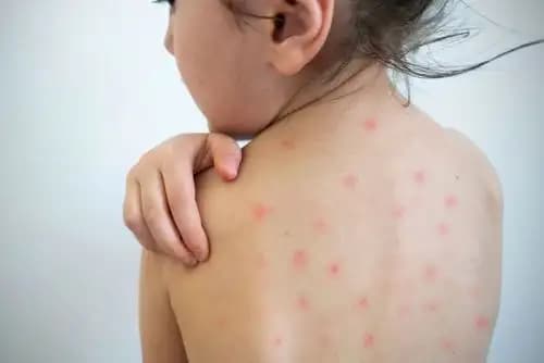 Alerta por dos casos sospechosos de sarampión en Huánuco