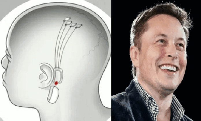 Compañía de neurotecnología implantará una computadora en el cerebro humano
