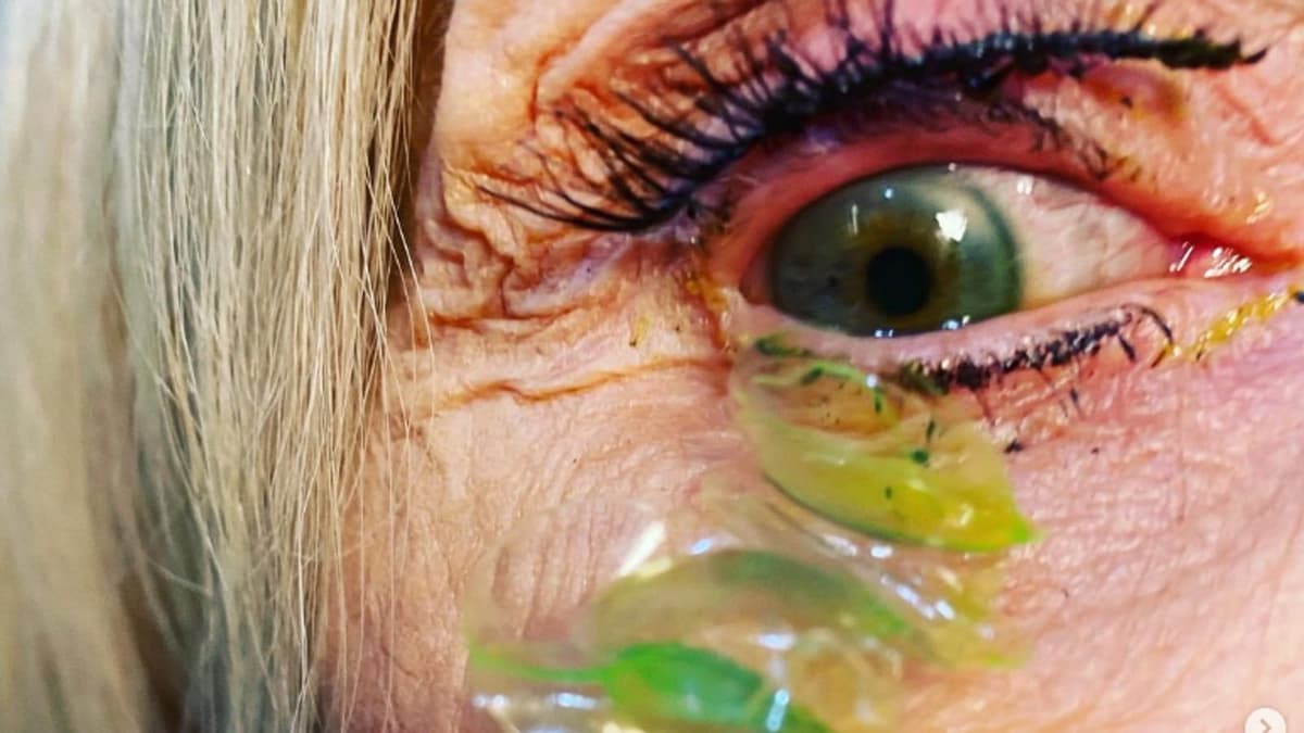 Médico extrae 23 lentes de contacto del ojo de paciente que 'olvidó quitárselos durante casi un mes'